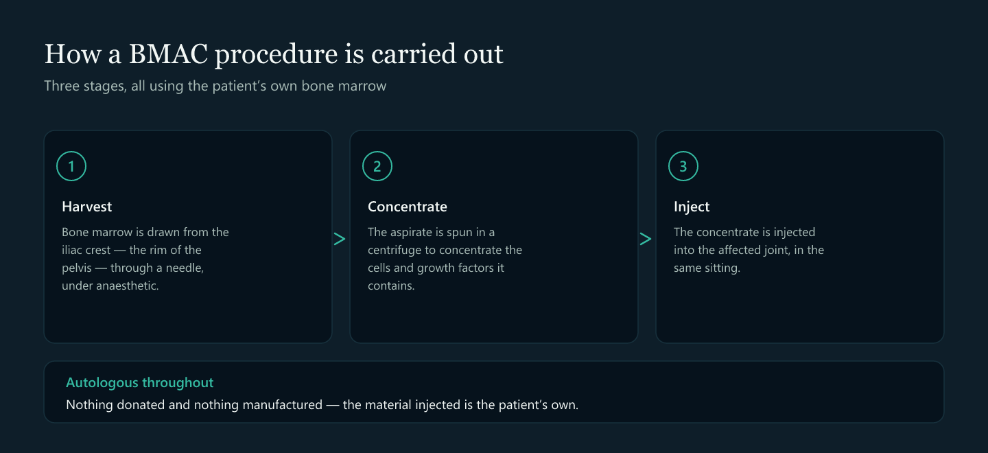 A three-step diagram: bone marrow harvested from the iliac crest, concentrated in a centrifuge, then injected into the joint